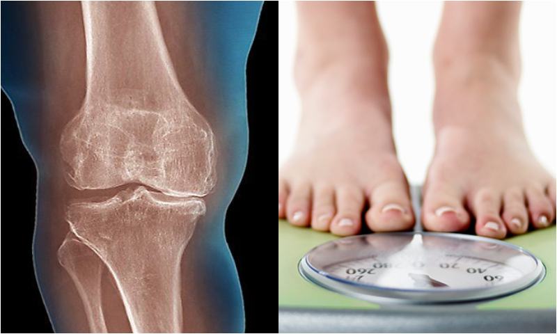 Can Weight Loss Help With Knee Osteoarthritis